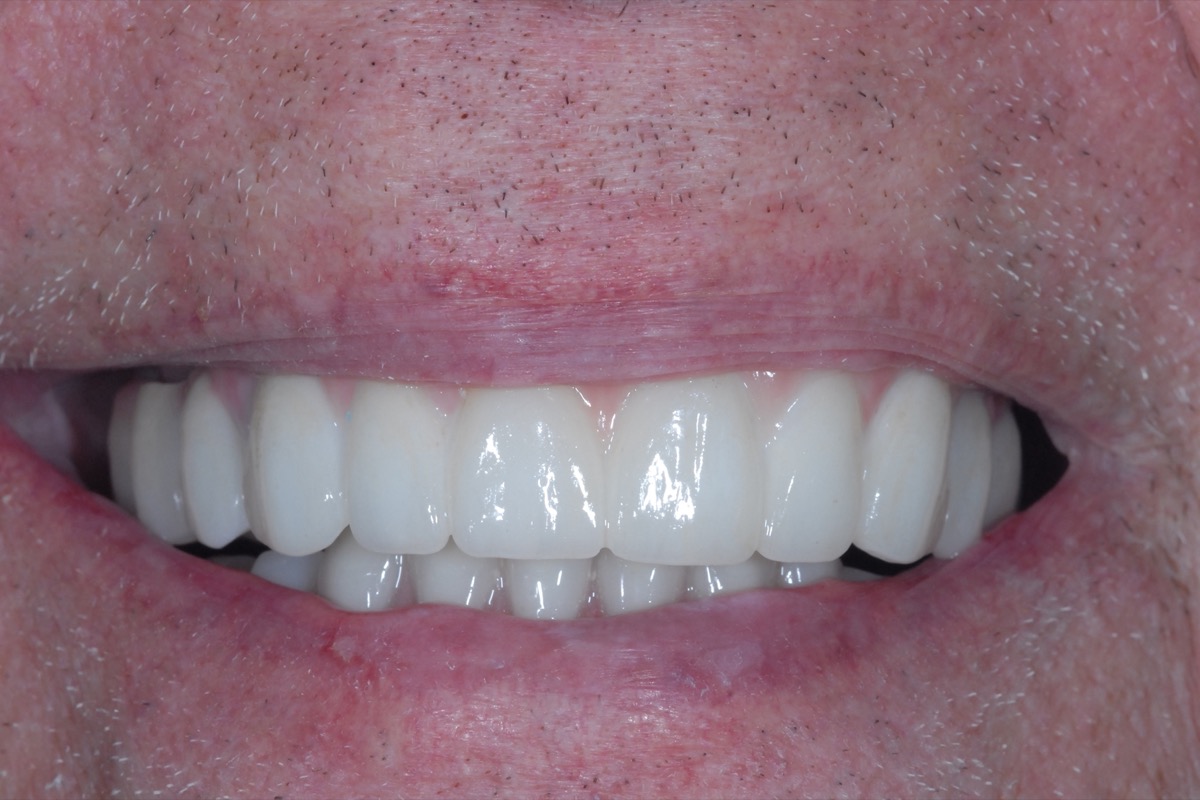 After — full-arch bridges on six implants in each arch, even in shade, length and alignment