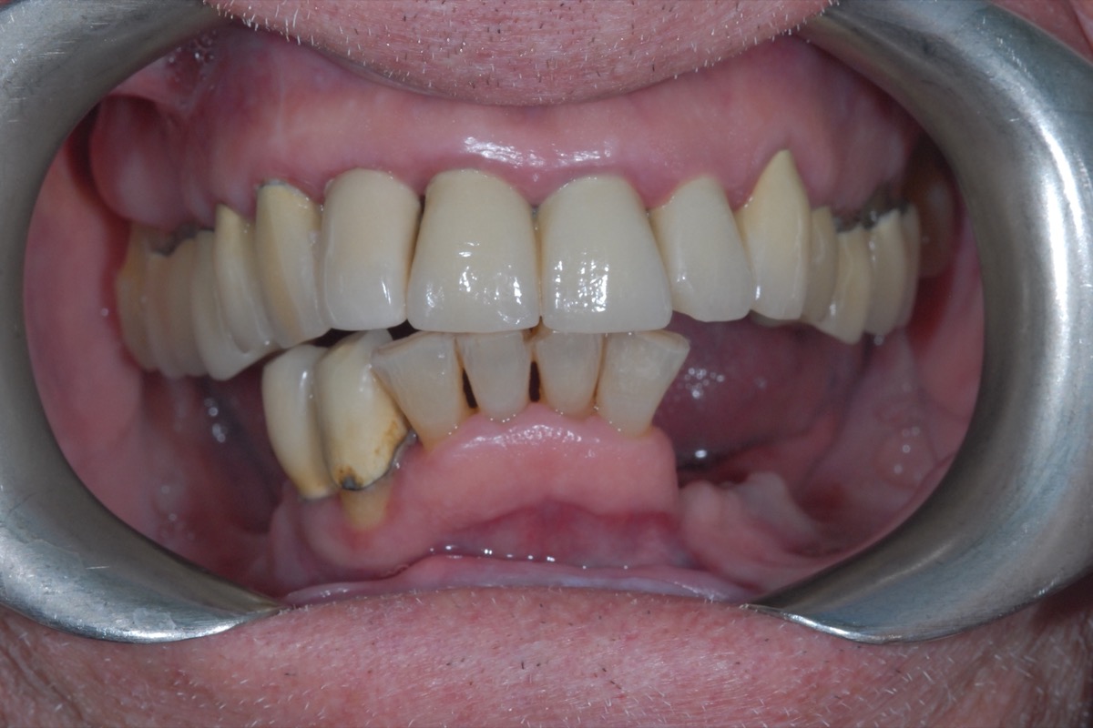 Before — crowded lower teeth, worn and stained, with the gums receded