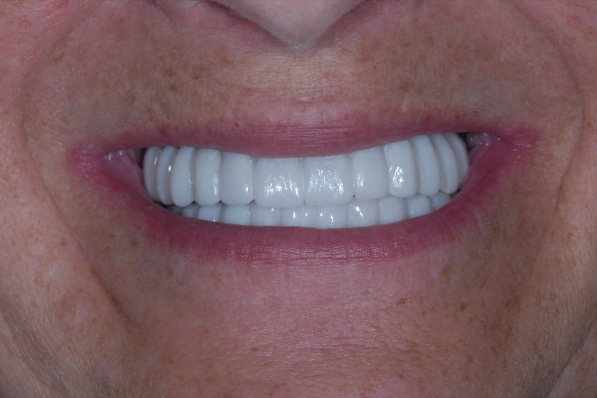 After — fixed bridges on six implants in each arch, the bite opened back to full height