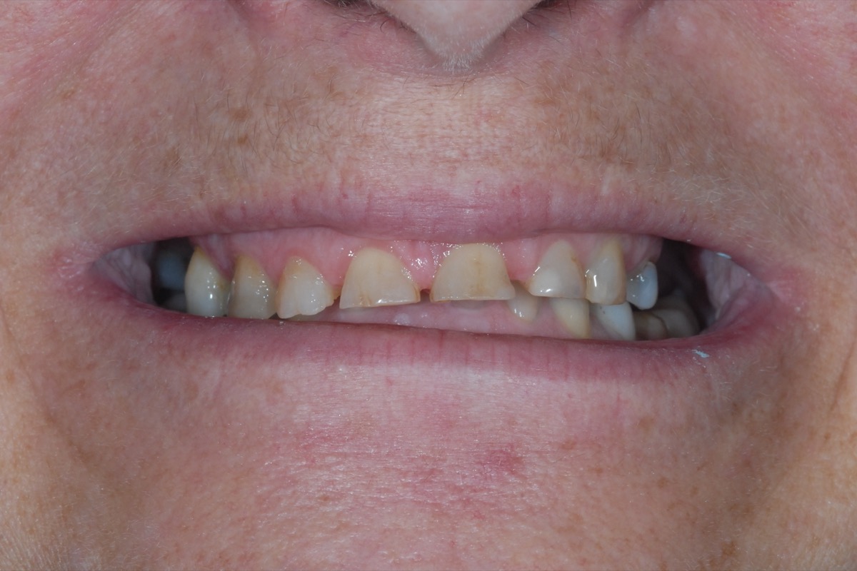 Before — teeth worn flat and short, the bite closed down with them