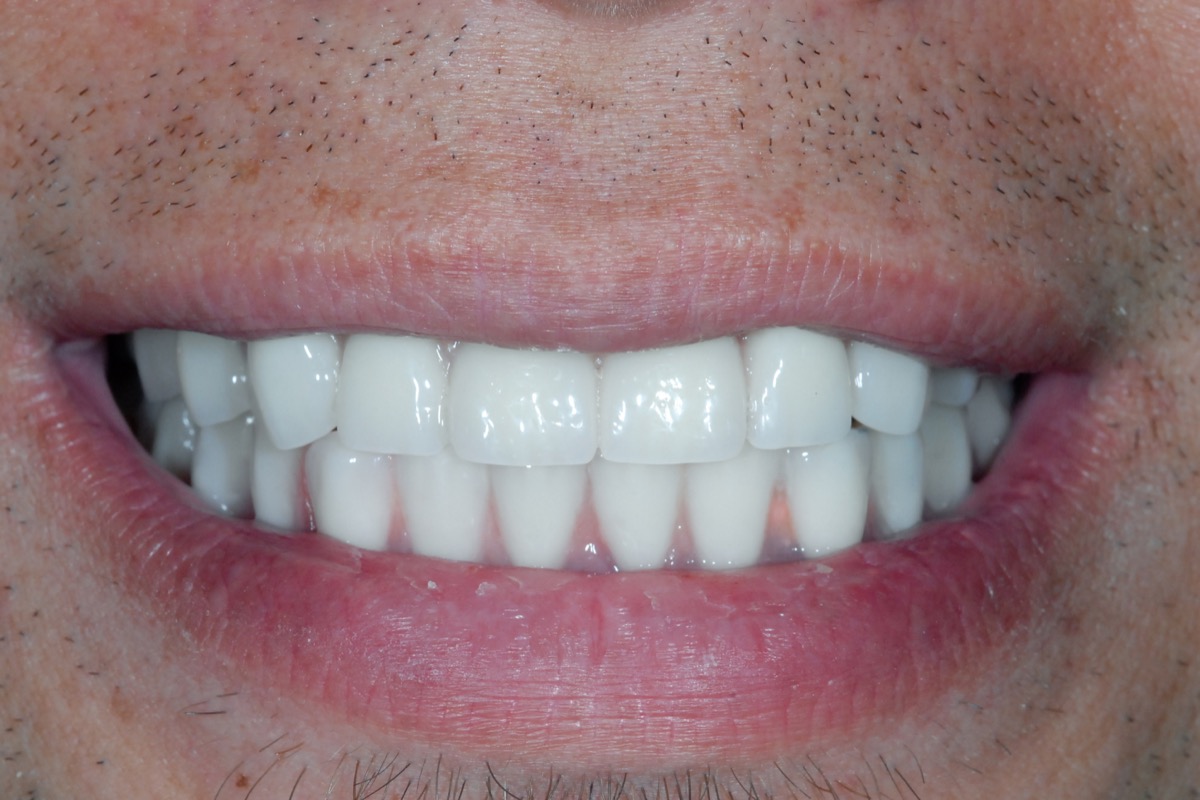 After — fixed bridges on six implants in each arch, even in shade, length and spacing