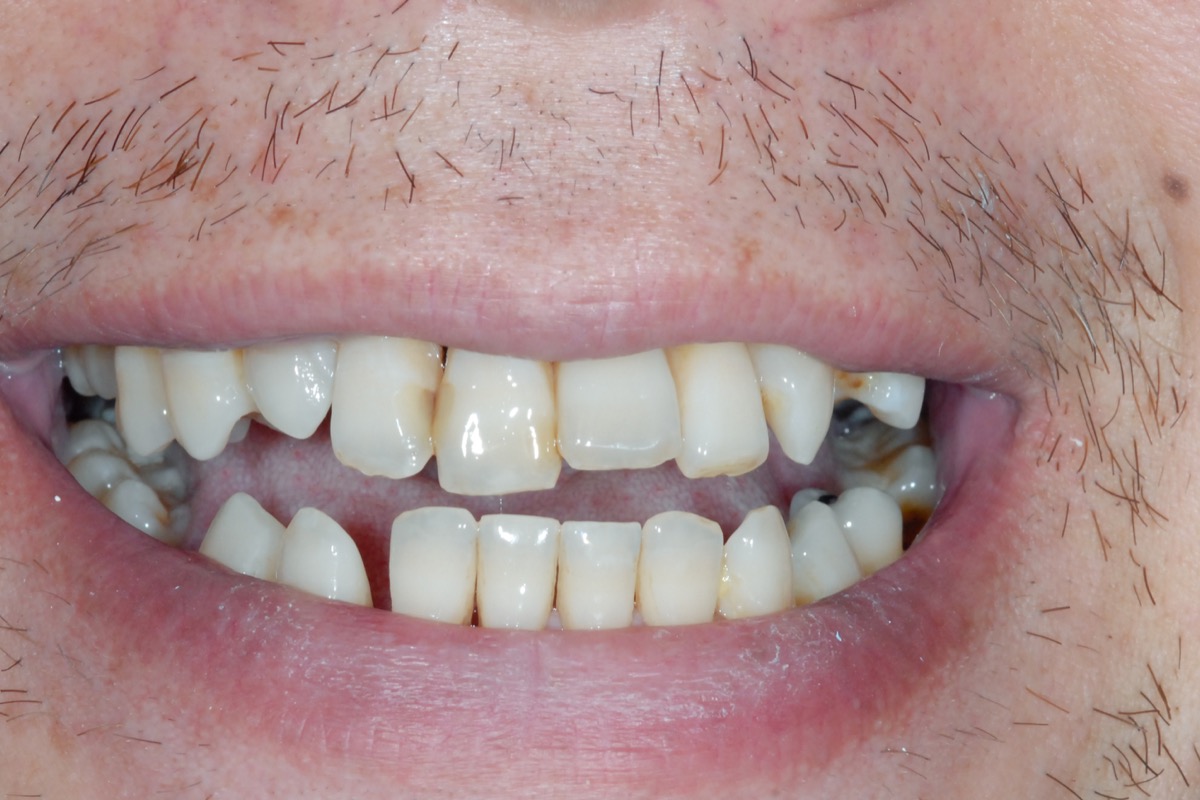 Before — short, worn teeth with gaps between them and the biting edges broken away