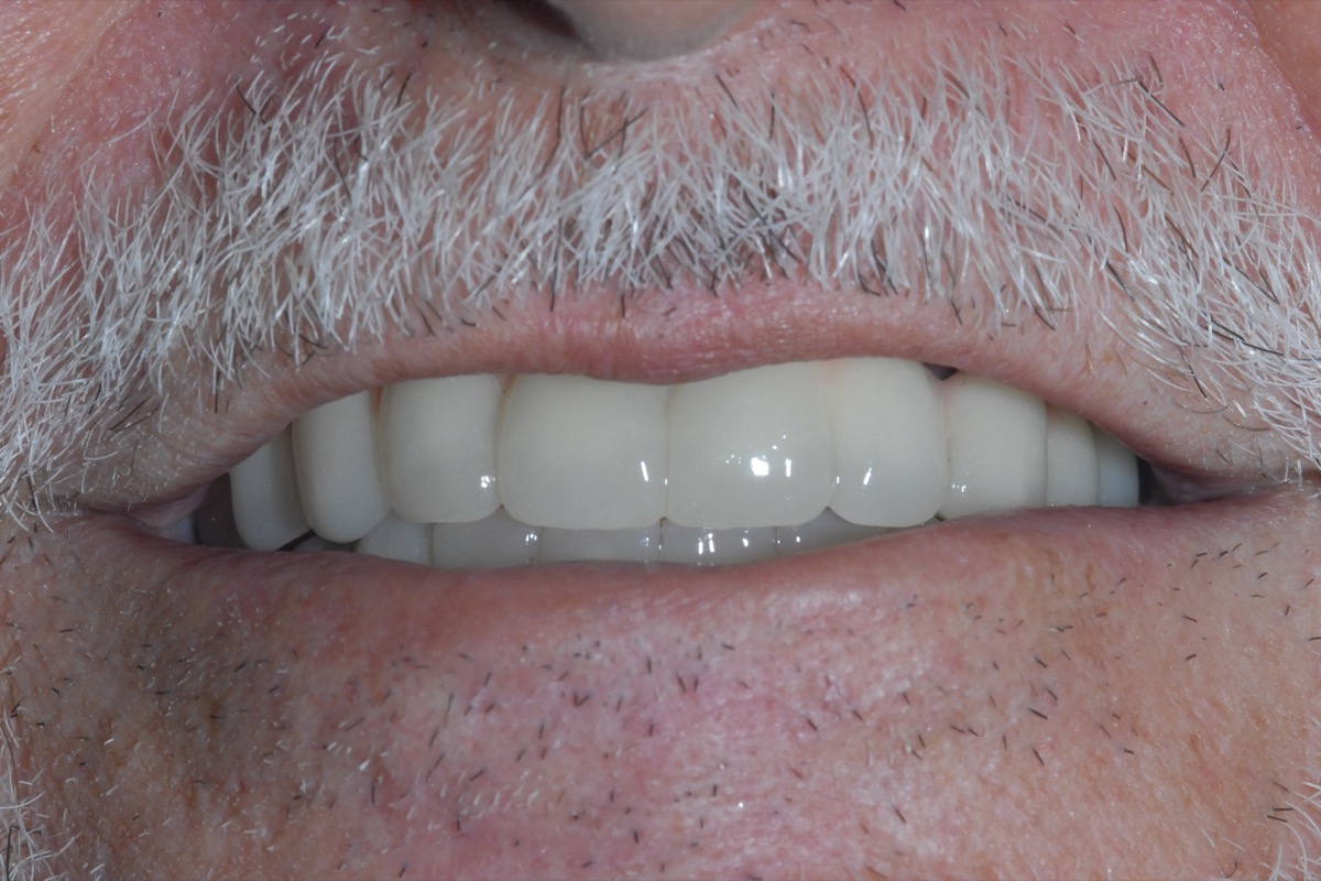 After — both arches restored on All-on-6 implants, the lip supported and the smile line natural