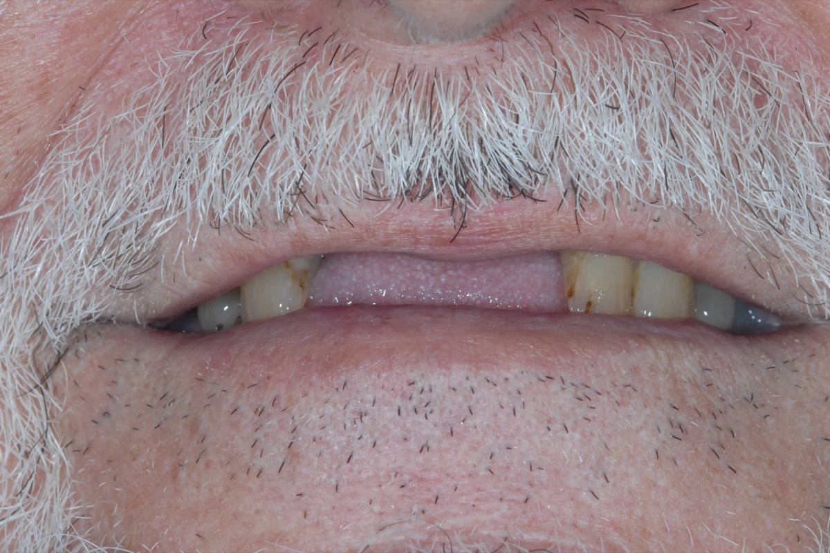 Before — the front teeth missing and the lower lip sagging without support, no teeth visible