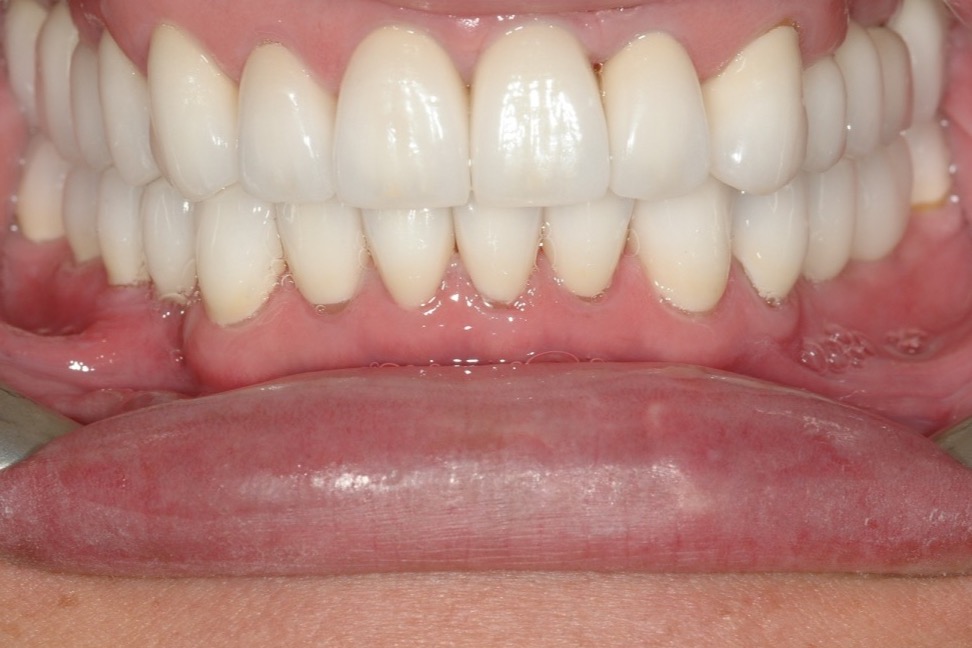 After — the arch complete, implant crowns and restored teeth matched in shade and length