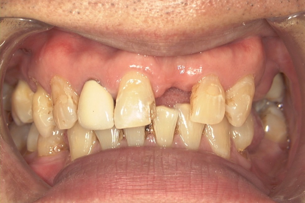 Before — gaps where teeth had been lost, the remaining teeth worn short and uneven