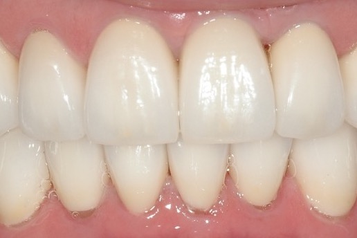 After — close on the front teeth, full in length and even at the edges