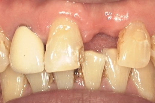 Before — close on the front teeth, worn to stubs with a gap between them
