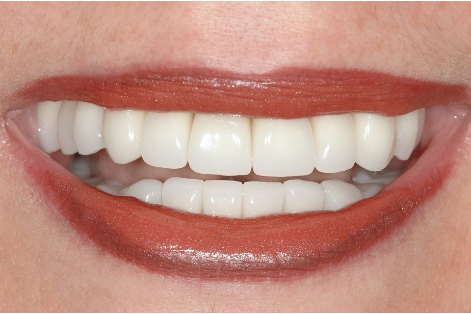 After — implants and porcelain crowns, the arch complete and restored in length