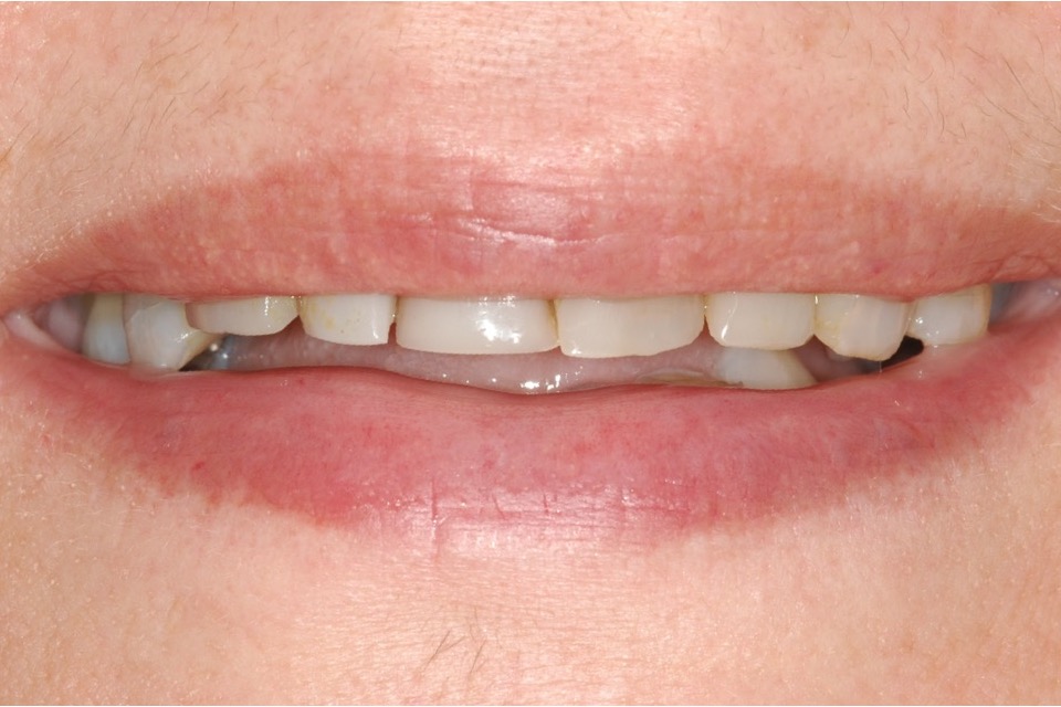 Before — worn, shortened teeth with gaps where teeth had been lost