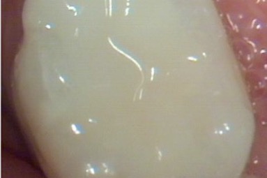 After — the same tooth, closer in and at a slightly different angle, with a porcelain inlay bonded in place