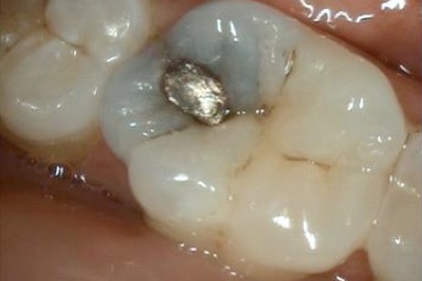 Before — the tooth with an old metal filling and a crack running across the biting surface