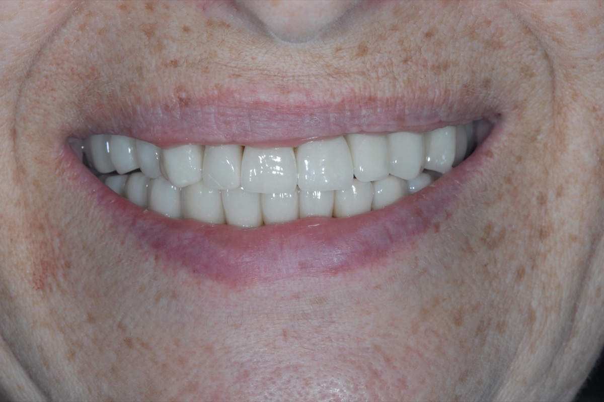 After — individual implants restoring each gap, with the remaining teeth rebuilt around them