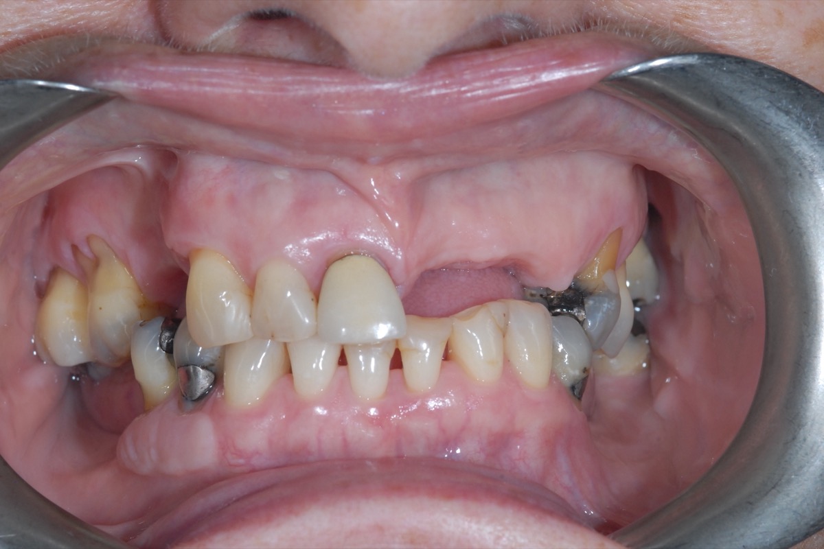 Before — gaps where individual teeth had been lost, the remaining teeth worn and discoloured