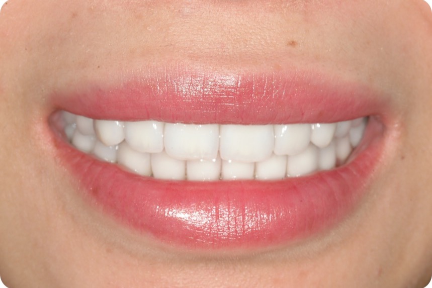 After — crowns on all of the teeth, even in shade and rebuilt in structure
