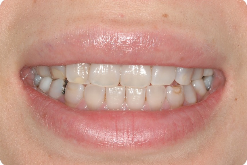 Before — grey banded discolouration across the teeth, with patches of thin, underdeveloped enamel