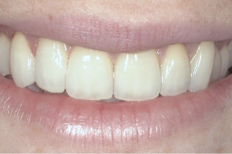 After — porcelain crowns and veneers across the upper front teeth, straight and even in shade