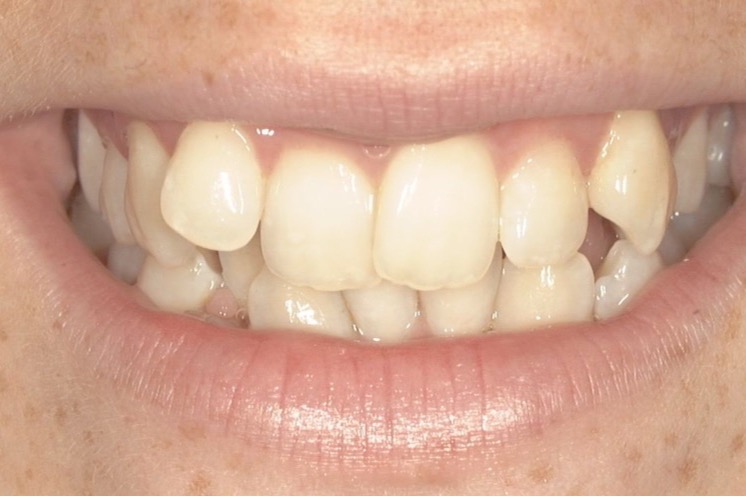 Before — crowded upper front teeth, overlapping and rotated out of line