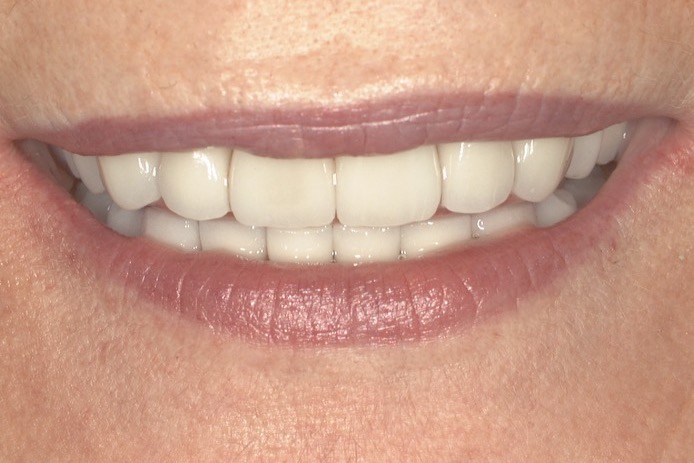 After — porcelain crowns and veneers on both arches, the teeth restored to their full length and the bite opened