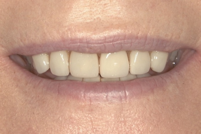 Before — worn, shortened teeth, the upper and lower front edges meeting almost flat and the lips drawn close together