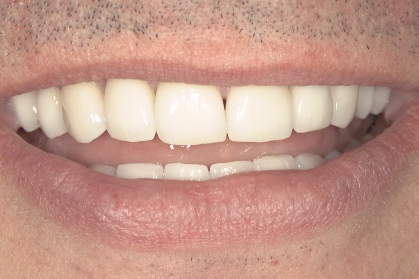 After — eight porcelain veneers across the upper arch, the gap closed and the edges even
