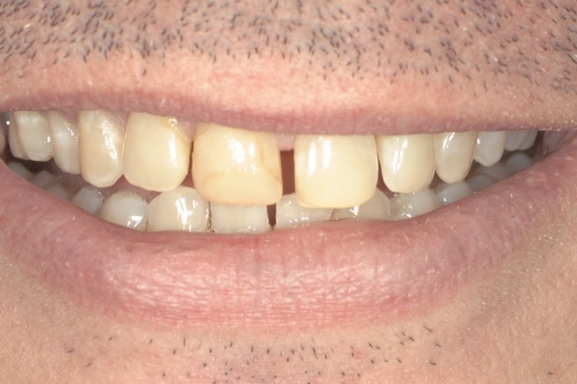 Before — a dark gap between the upper front teeth, with staining and chipped, uneven edges