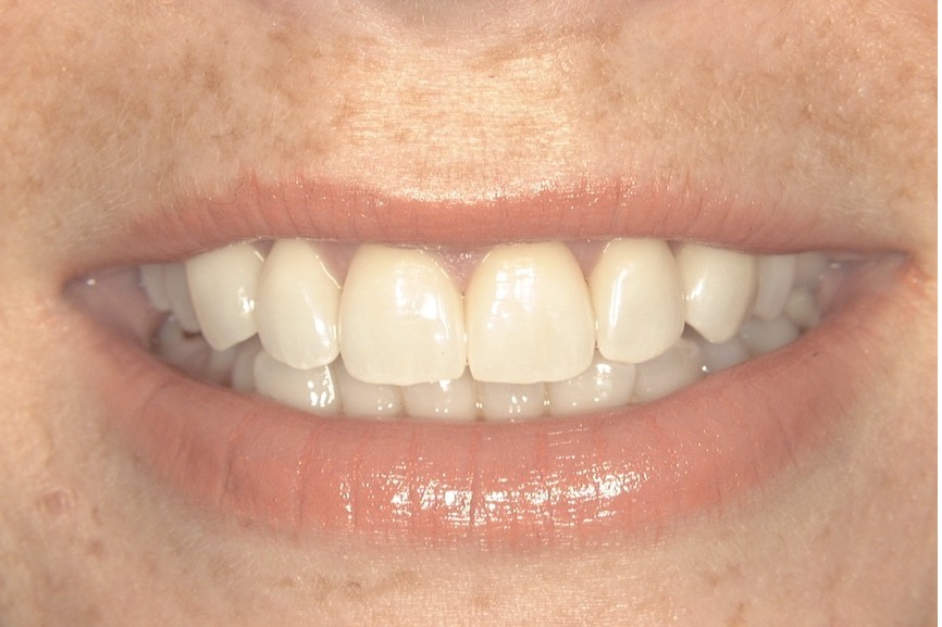 After — six porcelain veneers across the upper front teeth, even in shade and edge alignment