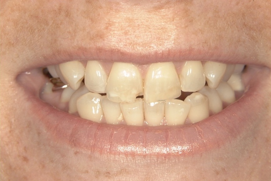Before — upper front teeth yellowed and uneven along the biting edges