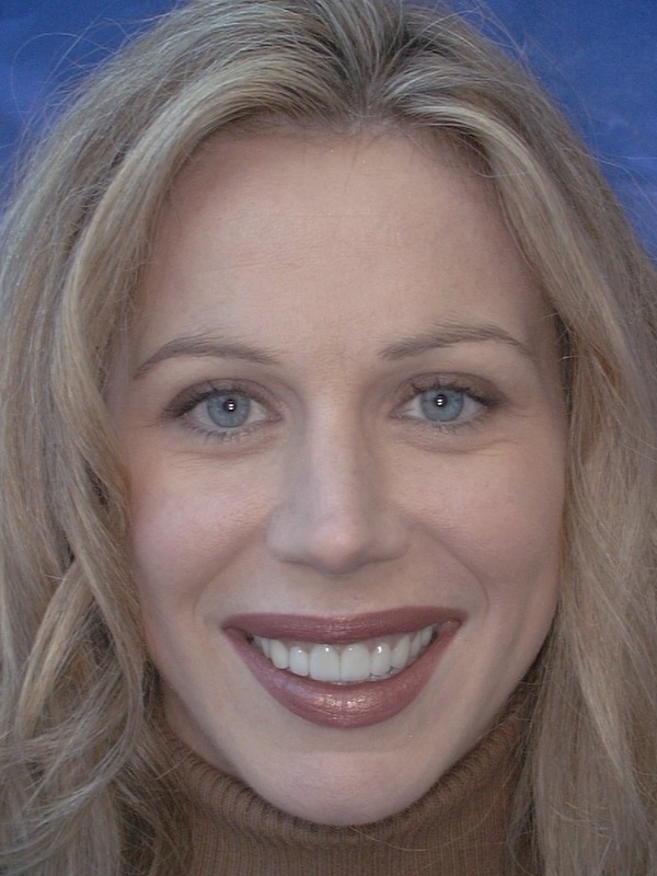 After — eight porcelain veneers and two crowns across the upper arch, even in shade, length and alignment