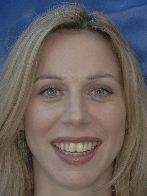 Before — upper front teeth uneven in shade and length, with visible wear along the edges