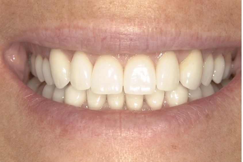 After — sixteen porcelain veneers, eight upper and eight lower, even in shade and alignment