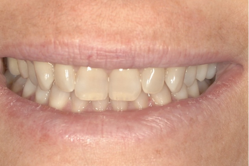 Before — deep discolouration across both arches, with the front teeth out of alignment