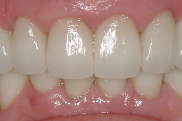 After — eight porcelain veneers across the front teeth, with the lower teeth whitened to match