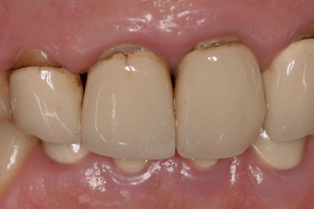 Before — front teeth uneven in shade, with dark margins along older restorations