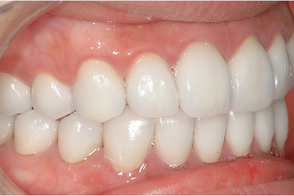 After — front teeth restored in porcelain, even in shade, length and alignment