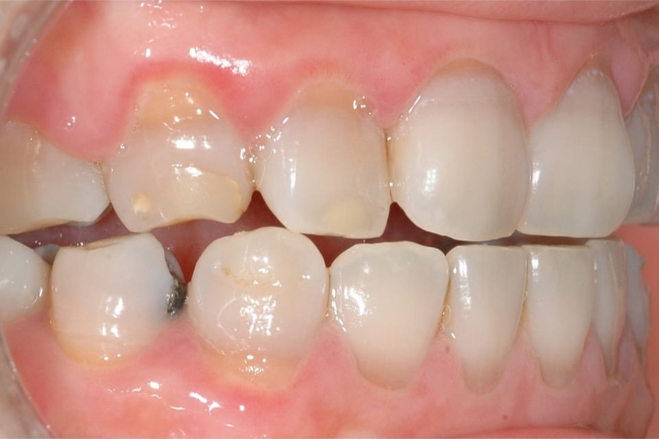 Before — front teeth worn and uneven, with old fillings visible at the edges