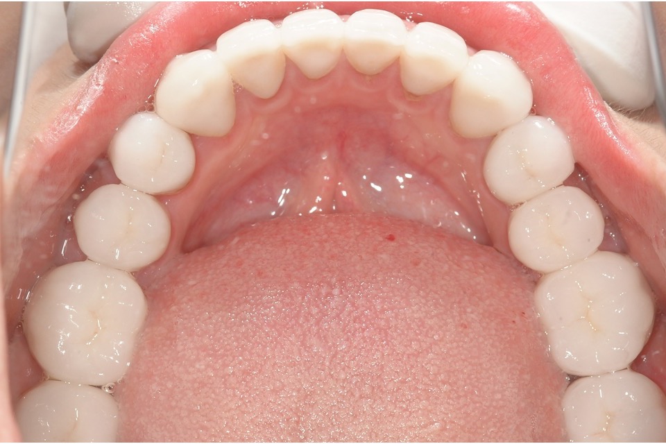After — lower back teeth rebuilt in porcelain, biting surfaces restored