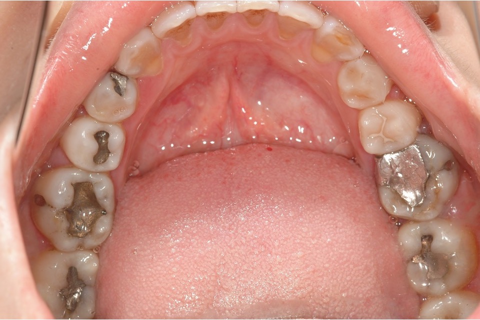 Before — lower back teeth with metal fillings and worn biting surfaces