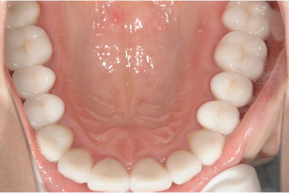 After — upper back teeth restored in porcelain across the whole arch
