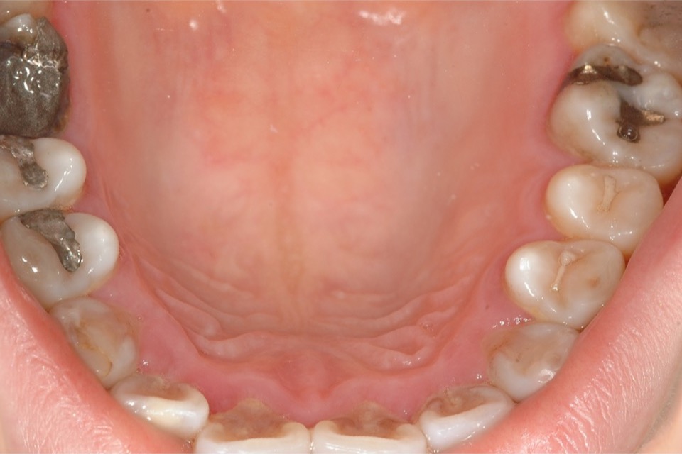 Before — upper back teeth carrying large metal fillings, with decay at the margins