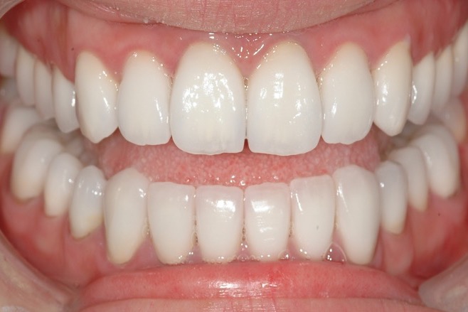After — crowns on all of the teeth, even in shade and restored to full length
