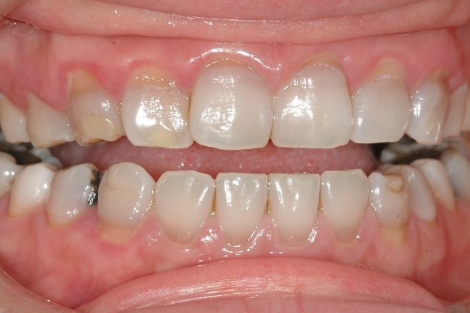 Before — teeth darkened by banded staining, short and worn along the edges