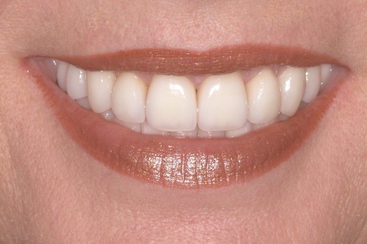 After — crowns, veneers and implant-supported teeth, even in shade with the gum line reshaped