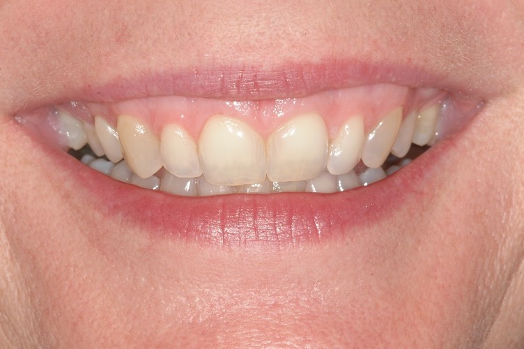 Before — worn and discoloured teeth with gaps where teeth had been lost, and an uneven gum line
