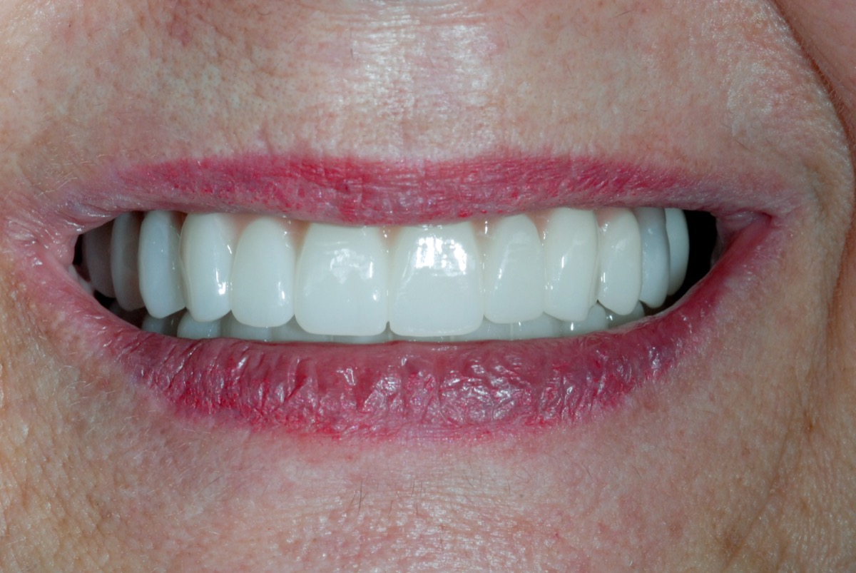 After — upper and lower arches restored on All-on-6 implants, even in shade, length and alignment