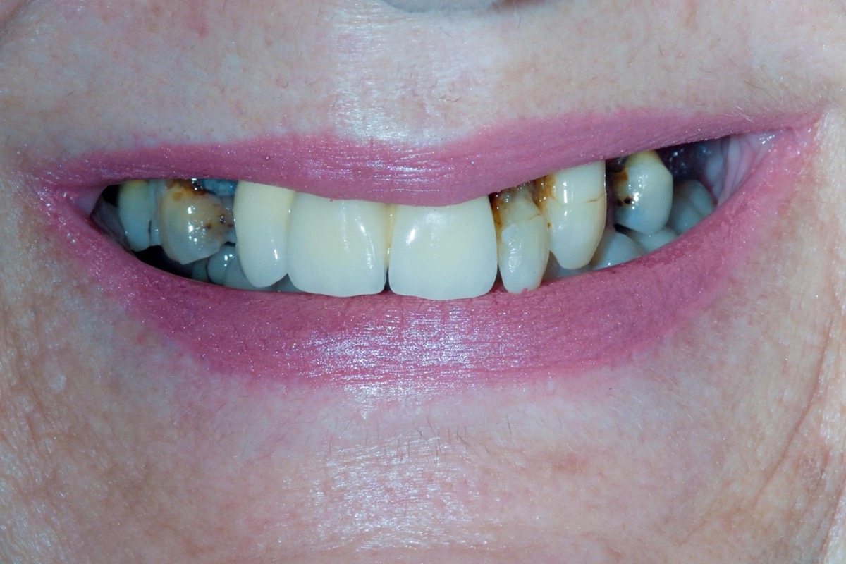 Before — heavily decayed upper teeth, dark staining at the gum line, uneven in shade and length
