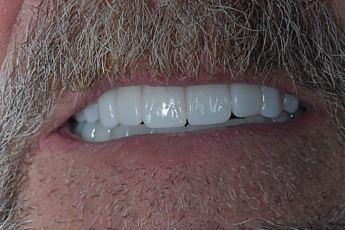 After — both arches restored, the lip supported and the smile visible
