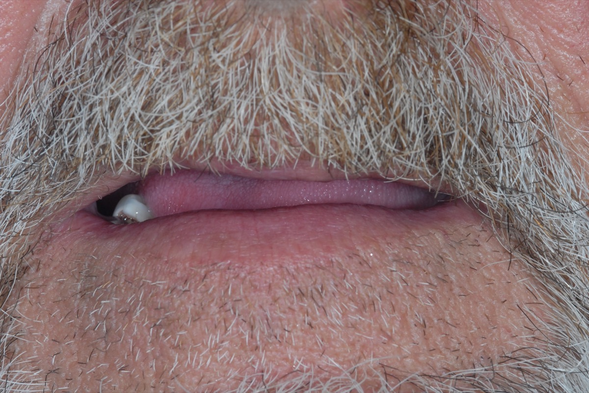Before — the upper lip unsupported and collapsed inward, the few remaining teeth hidden