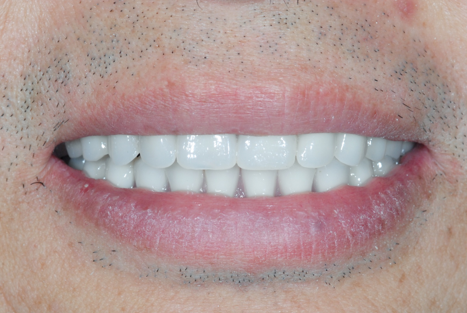 After — full mouth reconstruction, upper and lower arches