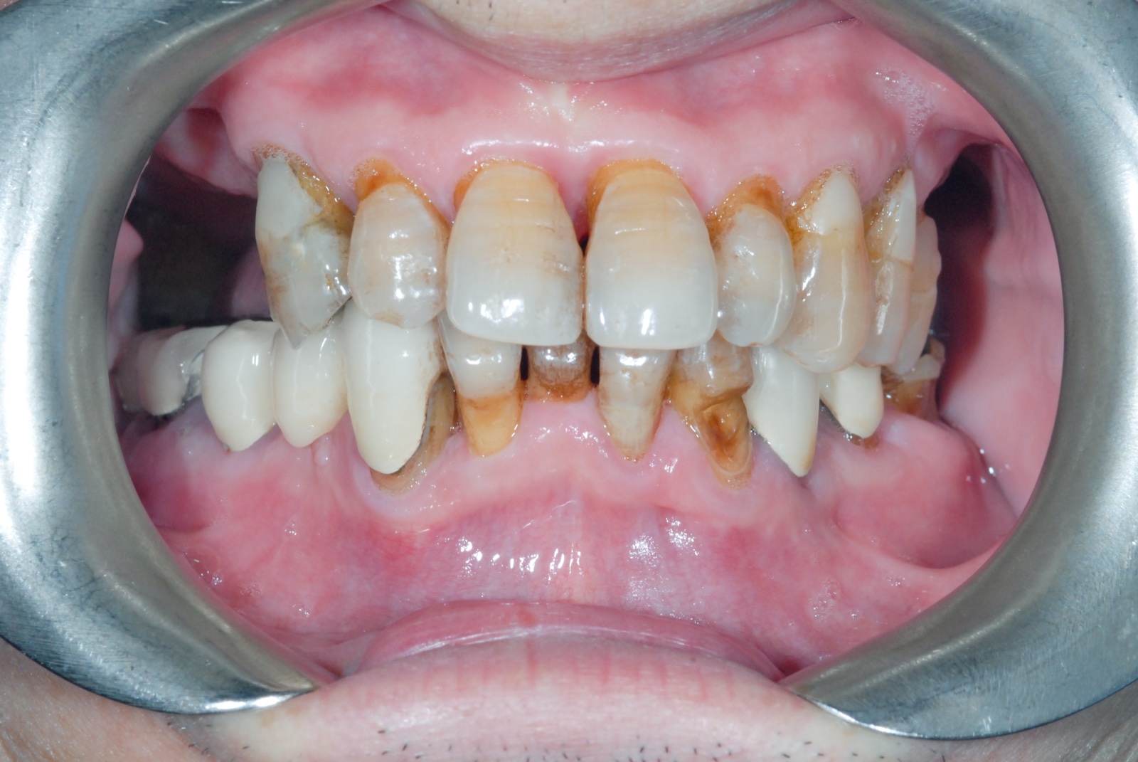 Before — full mouth reconstruction, upper and lower arches